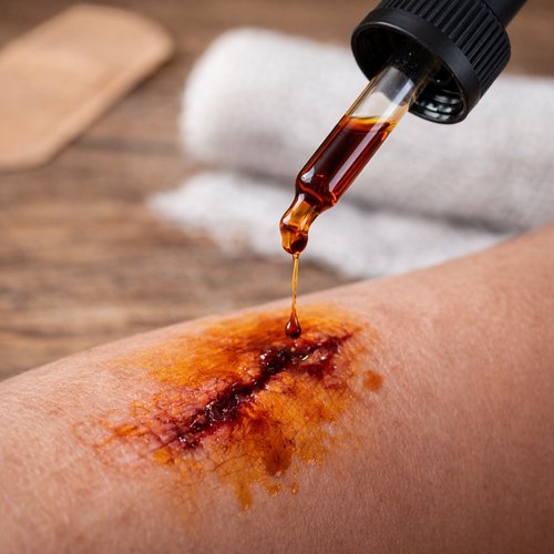 Iodine antiseptic being applied to a skin wound for disinfecting and preventing infection