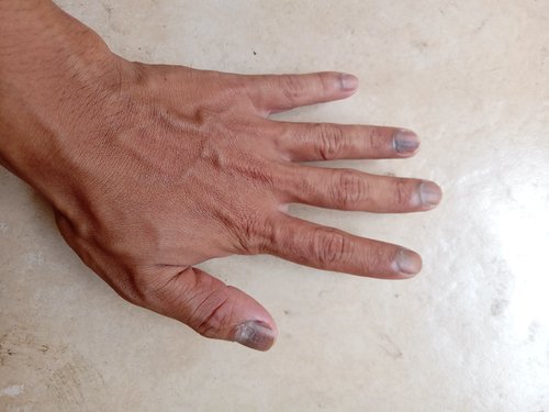 hand with bluish fingernails that may suggest reduced oxygen levels or circulation issues