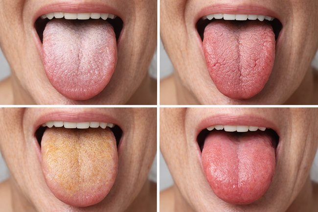 examples of tongue health signs including white coating cracked tongue yellow coating and healthy pink tongue