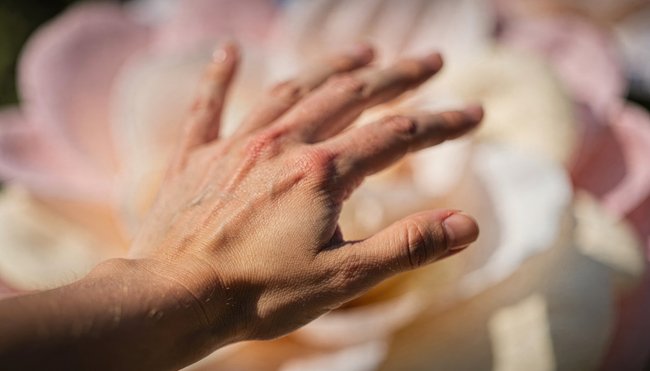 Hand showing visible veins, dry skin, and signs of poor circulation in the fingers.